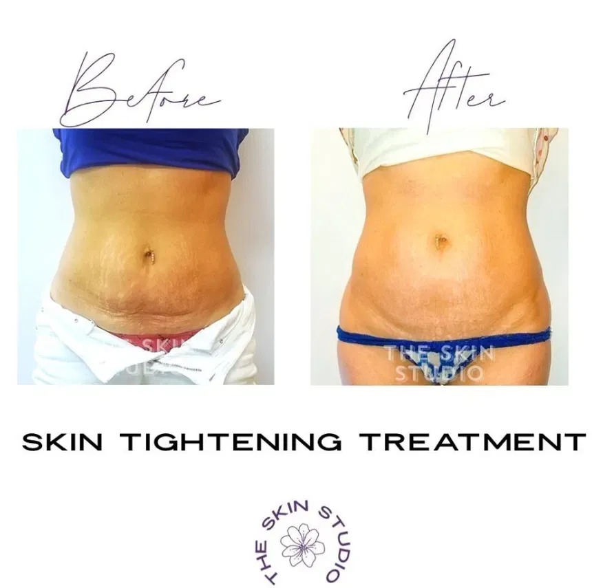 Venus Viva skin tightening transformation